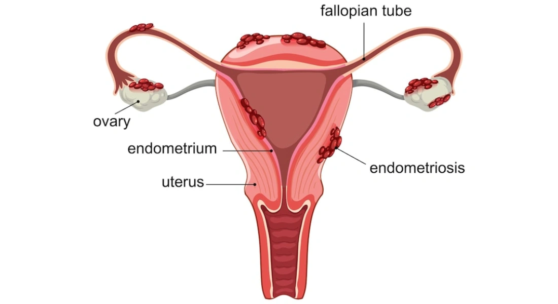 Endorelief Product